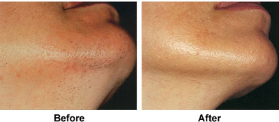 Electrolysis permantly removes unwanted chin hair.  Use electrology to get rid of unsightly hair anywhere on your body!